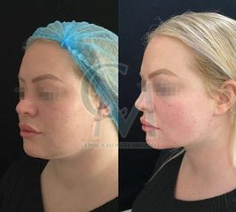 Bichectomia-lipofilling-natural - Clínica Montecarmelo
