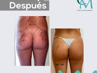 Aumento glúteos antes y después - 876215