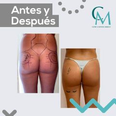 LIPOFILING 1 ANTES Y DESPUES - Clínica Montecarmelo