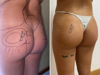 Lipofilling antes y después - 876216