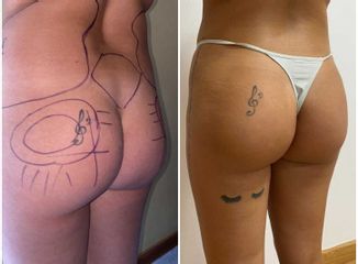Lipofiling- Clínica Montecarmelo