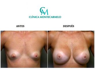 Aumento Mamario - Clínica Montecarmelo