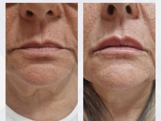 Aumento labios antes y después - 876324
