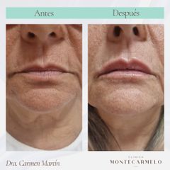 Clínica Montecarmelo - Relleno Labios