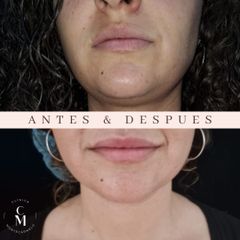 Clínica Montecarmelo - Relleno Labios