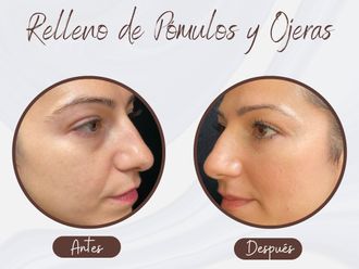 Eliminación ojeras antes y después - 876326