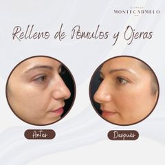 Clínica Montecarmelo - Relleno Pómulos y Ojeras