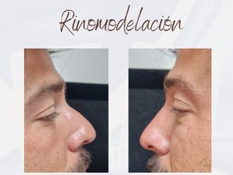 Rinomodelación antes y después - 876327