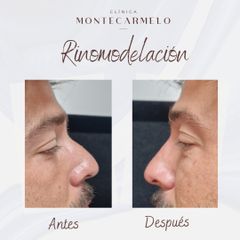 Clínica Montecarmelo - Rinomodelación
