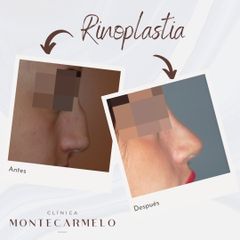 Clínica Montecarmelo - Rinoplastia