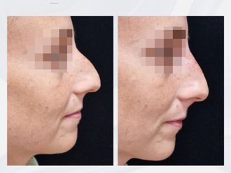 Rinoplastia antes y después - 876329