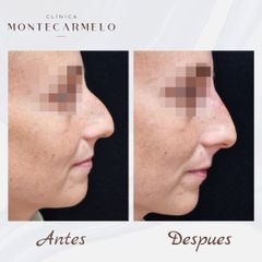 Clínica Montecarmelo - Rinoplastia