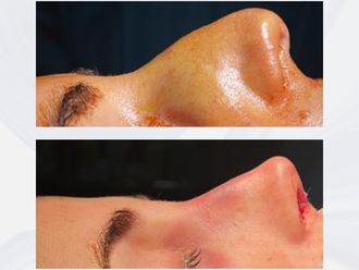 Rinoplastia antes y después - 876330