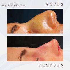 Clínica Montecarmelo - Rinoplastia