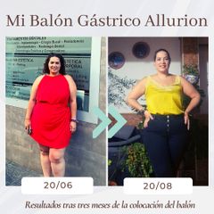 Clínica Montecarmelo - Balón gástrico