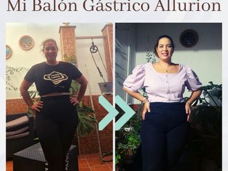 Balón gástrico antes y después - 876332