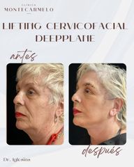 Lifting - Clínica Montecarmelo