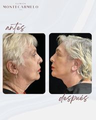 Lifting - Clínica Montecarmelo