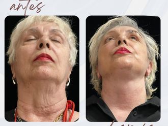 Lifting antes y después - 878141