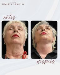 Lifting - Clínica Montecarmelo