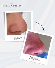 Rinoplastia - Clínica Montecarmelo
