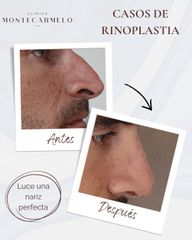 Rinoplastia - Clínica Montecarmelo