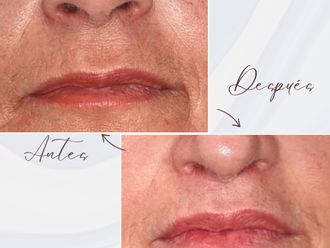 Aumento labios antes y después - 878145