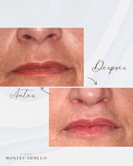 Aumento de labios - Clínica Montecarmelo
