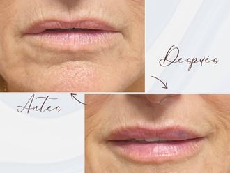 Aumento labios antes y después - 878146