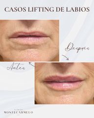 Aumento de labios - Clínica Montecarmelo