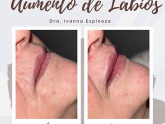 Aumento labios antes y después - 878147