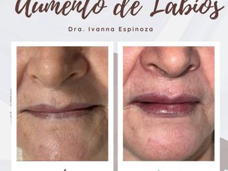 Aumento labios antes y después - 878148