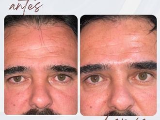 Blefaroplastia antes y después - 878149