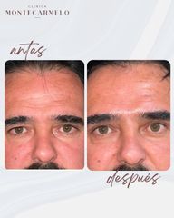 Blefaroplastia - Clínica Montecarmelo