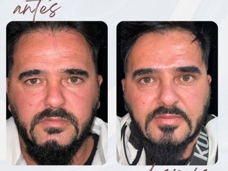 Bichectomía antes y después - 878150