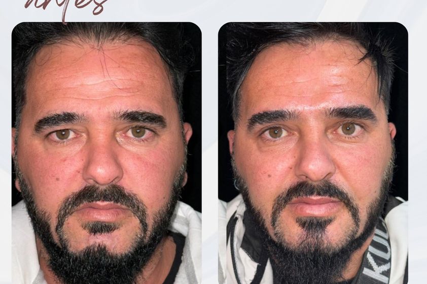 Bichectomía antes y después - 878150