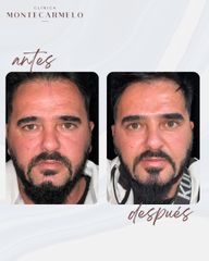 Bichectomia - Clínica Montecarmelo