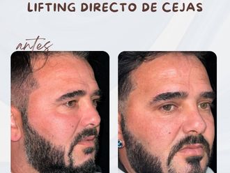 Bichectomía antes y después - 878151