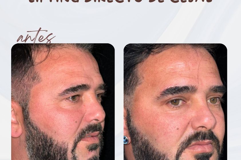 Bichectomía antes y después - 878151