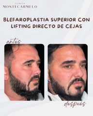 Bichectomia - Clínica Montecarmelo