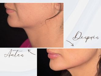 Ácido hialurónico antes y después - 878152