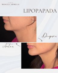 Lipopapada - Clínica Montecarmelo