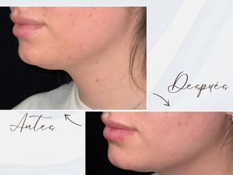 Liposucción de papada antes y después - 878153