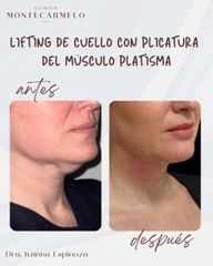 Lifting de cuello
