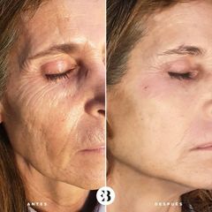 Rejuvenecimiento Facial PlexR Dra Elena Berezo