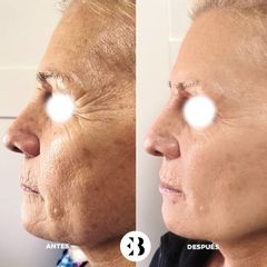 Botox Dra Elena Berezo