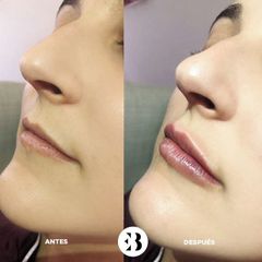 Aumento de labios Dra Elena Berezo