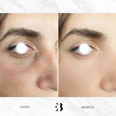 Eliminación de ojeras - Dra. Elena Berezo