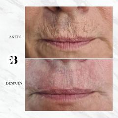 Rejuvenecimiento facial - Dra. Elena Berezo