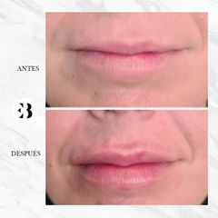 Aumento de labios - Dra Elena Berezo